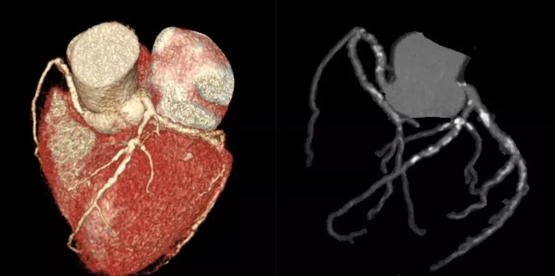 利用高端螺旋ct扫描,再经过计算机处理重建得出的心脏冠状动脉成像的